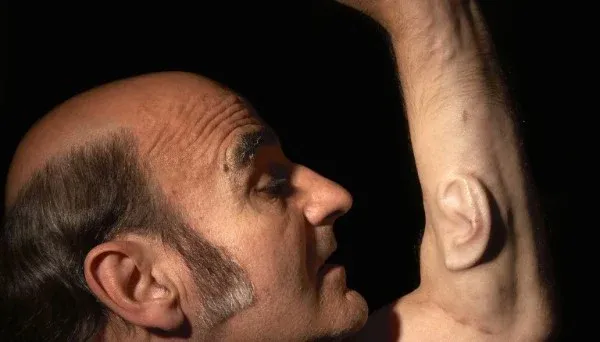 Extra Ear: Ear on Arm by Stelarc (2008). The ear is a permanent fixture on Stelarc’s arm, having integrated the biocompatible frame surgeons inserted under the skin into its own tissue and blood supply within six months.
